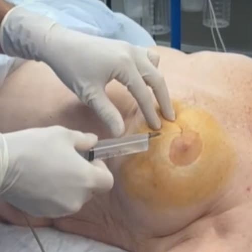 chirurgie mammaire perfusion anesthesie locale sedation cancerologie mammaire institut bourdonnais paris dr delphine hequet dr julien seror oncologie paris chirurgie mammaire perfusion anesthesie locale sedation cancerologie mammaire institut bourdonnais paris dr delphine hequet dr julien seror oncologie paris