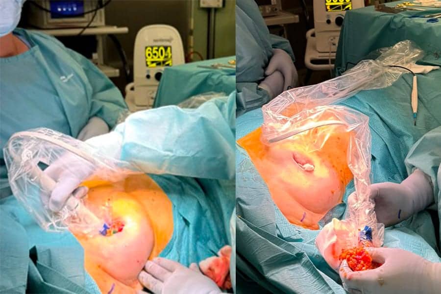 Le repérage préopératoire des cancers du sein par clip magnétique