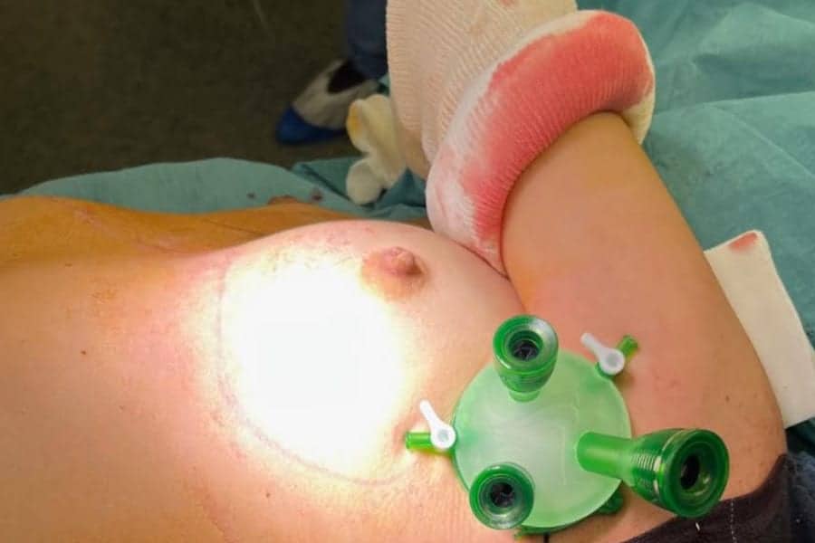 endoscopie mastectomie reconstruction mammaire chirurgie sein institut bourdonnais paris